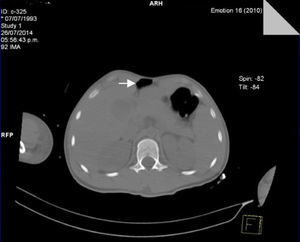 Tomografía simple de abdomen, corte axial. Debajo de cúpula diafragmática y adyacente a la pared anterior se aprecia aire libre intraabdominal sin evidencia de lesión a víscera hueca.