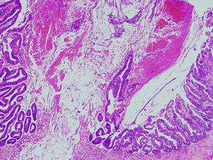 Adenoma túbulo-velloso con displasia epitelial de alto grado (x5, hematoxilina-eosina). Abundantes glándulas epiteliales displásicas. Lagos de moco acelular en capa muscular propia.