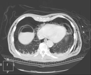 Tomografía axial computada corte toracoabdominal: neumomediastino, neumoperitoneo y enfisema subcutáneo bilateral.