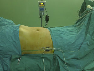 Medición de la presión intraabdominal utilizando el kit Abviser ABV 611.