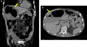Imagen coronal (A) y axial (B) por tomografía donde se observa el ciego dilatado y en posición ectópica (flechas).