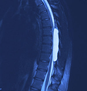 Corte de resonancia magnética sagital de columna torácica en T2 donde se observa quiste aracnoideo con compresión medular sobre el muro posterior de las vértebras y datos de mielopatía.