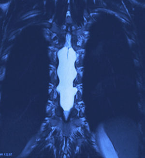 Corte de resonancia magnética coronal donde se observa el quiste aracnoideo de T6 a T9.