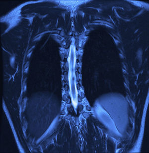 Imágenes de resonancia magnética de columna torácica en secuencia T2 posquirúrgicas, donde se muestra la resección completa del quiste, sin datos de compresión o recurrencia de la lesión. A la izquierda, corte sagital. A la derecha, corte coronal.