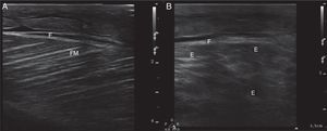 A. Imagen ultrasonográfica en modo 2D en corte longitudinal en el músculo recto femoral izquierdo normal de un paciente sano, apreciándose fascia muscular (F) de diámetro conservado y fascículos musculares (FM) distribuidos de manera oblicua y homogénea, imagen característica en haces de paja. B. Imagen ultrasonográfica en modo 2D del músculo recto femoral izquierdo con rabdomiólisis, en la que se observa engrosamiento de la fascia muscular (F), pérdida de la orientación de los fascículos musculares con disminución de la ecogenicidad y zonas anecoicas (E).