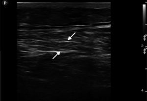Imagen ultrasonográfica en modo 2D del recto femoral izquierdo en paciente con rabdomiólisis en la que se observan áreas hiperecoicas intramusculares y distribución desorganizada de los fascículos musculares (flechas).