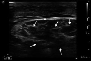 Imagen ultrasonográfica en modo 2D del músculo recto femoral izquierdo en corte longitudinal apreciándose zonas anecoicas abundantes, compatibles con edema (flechas), e incremento del diámetro de la fascia del músculo (*).