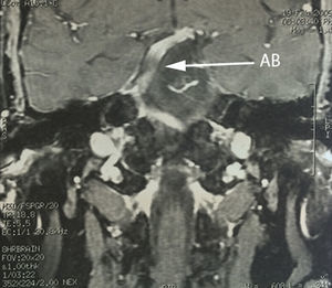 Corte coronal de imagen por resonancia magnética secuencia T1 contrastado, donde se observa curso dolicoectásico de la arteria basilar (AB) hacia la derecha en su ascenso por el tallo cerebral.