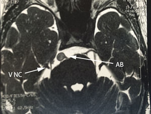 Corte axial de resonancia magnética secuencia FIESTA, donde se aprecia el desplazamiento y compresión del nervio trigémino (V NC) en su porción cisternal del lado derecho. Arteria basilar (AB).