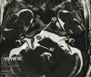 Corte axial de la imagen por resonancia magnética secuencia FIESTA donde se observa la compresión y desplazamiento del complejo nervioso vii-viii (VII-VIII NC) por la arteria vertebral derecha (AV) antes de su unión a la arteria basilar (AB)