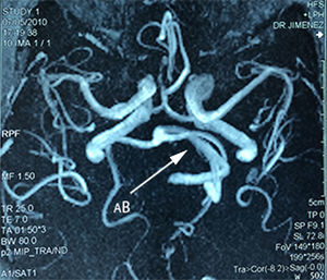 Reconstrucción vascular por angiorresonancia magnética, donde se observa dolicoectasia vertebrobasilar (AB) hacia la izquierda.