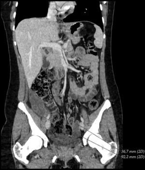 Tomografía computada abdominal urgente con contraste intravenoso: con colección retrocecal encapsulada de 36.7×92.2mm.