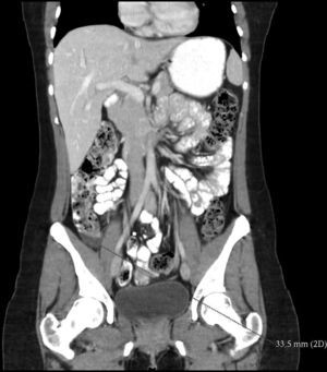 Tomografía computada de control (realizada 2 años después de la resección del tumor), donde se aprecia una lesión de 33.5mm sospechosa de recidiva tumoral.