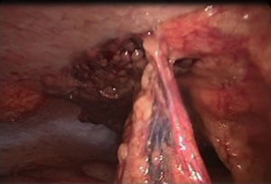 Laparoscopia diagnóstica, se observa necrosis de tejido adiposo.