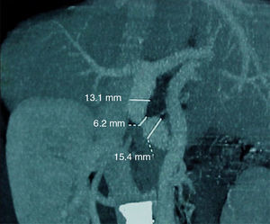 Angio-TAC esplenoportal postrasplante hepático. Presencia de flujo portal adecuado a través de la anastomosis de la vena gastroepiploica derecha-vena porta donante.