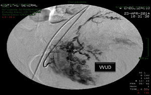 Embolización selectiva de arteria uterina derecha. VVU: vascularización vesicouterina derecha.