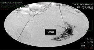 Embolización de arteria uterina izquierda. VVUI: vascularización vesicouterina izquierda.