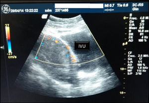 Ultrasonografía doppler. IVU: interfase vesicouterina.