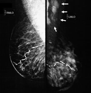 Mastografía en posición oblicuo-lateral en la que se aprecia un engrosamiento difuso de la piel de la glándula mamaria izquierda, un patrón denso que sustituye el 80% del tejido mamario y se extiende en forma irregular al plano graso pre- y retromamario. Los trayectos vasculares se encuentran parcialmente calcificados. En la región axilar izquierda se identifican múltiples adenopatías densas con pérdida del centro radiolúcido e invasión en tejidos blandos adyacentes (flechas).