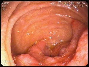 Gastroscopia: tumoración exofítica de tercera porción duodenal. Aspecto endoscópico.