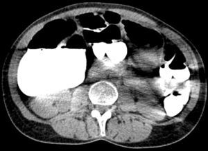 Tomografía de abdomen. Corte axial con dilatación cecal, nivel hidroaéreo, sin evidencia de neumatosis intestinal ni líquido libre.