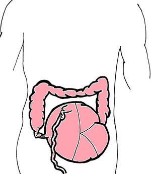 Esquema que ilustra el vólvulo cecal con torsión axial del ciego, colon ascendente e íleon terminal.