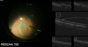 Imagen de tomografía de coherencia óptica transquirúrgica, que muestra la elevación de la membrana limitante interna en forma de cúpula en el sitio en donde había estado presente una hemorragia sublimitante, en un paciente con síndrome de Tearson.