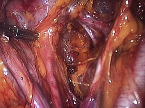 1) Espacio pararrectal, 2) espacio paravesical, 3) ligamento infundíbulo pélvico, 4) uréter, 5) parametrio derecho.
