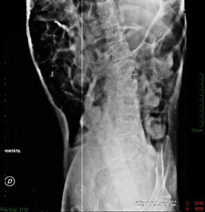 Radiografía simple de abdomen. Dilatación importante de asas de intestino grueso, ausencia de gas en el ámpula rectal y edema interasa.