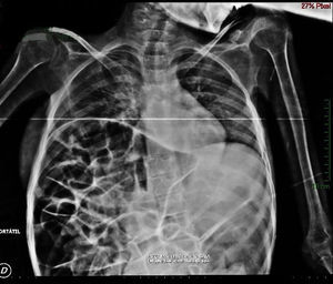 Radiografía portátil de tórax. Sombra hepática en hemidiafragma izquierdo.