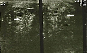 Imagen de ultrasonido testicular bilateral en la cual se observa testículo izquierdo heteroecogénico, trabeculado en tercio superior e imágenes quísticas y multifocales, con dimensiones de 25×18×20cm.