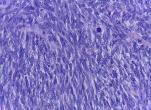 Hematoxilina eosina. Tumor testicular con características predominantemente fusiformes (10×).