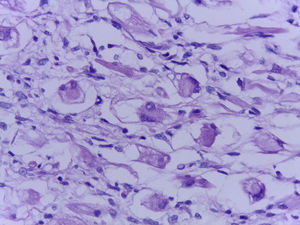 Hematoxilina eosina. Rabdomioblastos con núcleo grande, nucléolo prominente, citoplasma brillante con estrías entrecruzadas.