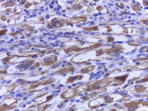 Inmunohistoquímica. Tinción de desmina positiva en células tumorales fusiforme (40×).