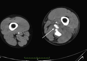Tomografía axial computada, la cual se encuentra con edema importante de extremidad inferior izquierda y fístula arteriovenosa con saco aneurismático.