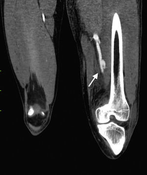 Tomografía axial computada: corte sagital observando la comunicación entre arteria femoral y la vena tras la administración de contraste.