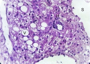 Ampliación a 40x de corte histológico de adenoma hepático en el que se observan cambios esteatósicos, desorganización de elementos de la tríada portal y ausencia de atipia celular (tinción de hematoxilina y eosina). H: hepatocitos; S: sinusoide; V: vacuolas.