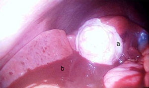 a) Aspecto macroscópico del carcinoma neuroendocrino de vesícula biliar. b) Hemoperitoneo.
