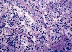 Carcinoma neuroendocrino de células pequeñas de la vesícula biliar.