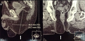Tomografía computada de pelvis en vista sagital (A) y coronal (B) que muestra la hernia perineal (flechas).