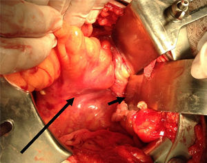 Separador quirúrgico metálico en el defecto herniario luego de reducir su contenido (flecha corta). Colon recto-sigmoide (flecha larga).