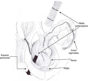 Diagrama que muestra la colocación de malla de polipropileno en el espacio pararrectal derecho, en la plastia perineal.