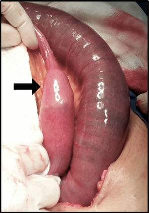 Fotografía transoperatoria en la que se aprecia sitio de impactación de lito (flecha negra). Distal se observa disminución de calibre intestinal y proximal, gran dilatación e hiperemia por compromiso parcial de perfusión de intestino delgado.