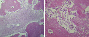 Tinciones histológicas con hematoxilina y eosina para el grupo B. A y B) El tejido de reparación se encuentra más organizado y con áreas extensas de tejido cartilaginoso, así como con poca presencia de osteoclastos (HE 20X).
