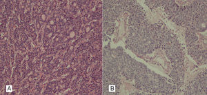 A) Imagen histológica con patrón pseudoglandular de hepatocarcinoma, con formación de luces glandulares. Hepatocyte paraffin 1 (Hep-Par1) positivo, citoqueratinas 7 y 20 negativas. B) Colangiocarcinoma poco diferenciado, en el que se distinguen luces glandulares y zonas de necrosis intratumoral. Citoqueratinas AE1-AE3 y 7 positivas; el Hep-Par1 y la citoqueratina 20, negativos.