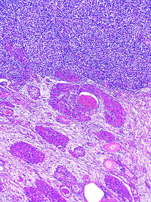 Los cortes histológicos de la resección de la lesión inguinal izquierda demuestran: parénquima testicular con atrofia, hiperplasia de células de Leydig y edema (parte inferior), con la presencia de un seminoma clásico puro (parte superior de la fotografía). (Hematoxilina y eosina, X100).