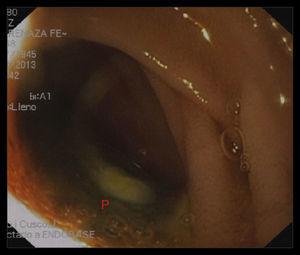 Endoscopia digestiva superior. P: exposición de prótesis de dacron a través de la luz duodenal.