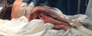 Paciente en decúbito lateral izquierdo, se muestra extensión de fascitis necrosante.
