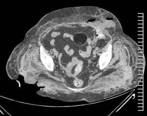 Tomografía axial computada abdominal simple: asa intestinal adosada a pared posterior, más aire libre en tejido celular subcutáneo.