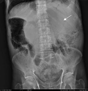 Radiografía simple de abdomen en decúbito. Se observa imagen en vidrio despulido localizada en hipocondrio izquierdo (flecha).